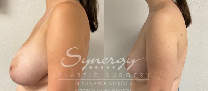 Before & After Breast Reduction Case 893 Left Side View in Austin, TX