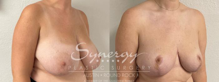 Before & After Breast Reduction Case 893 Right Oblique View in Austin, TX