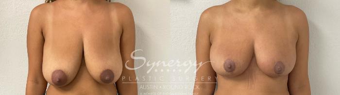 Before & After Breast Reduction Case 927 Front View in Austin, TX