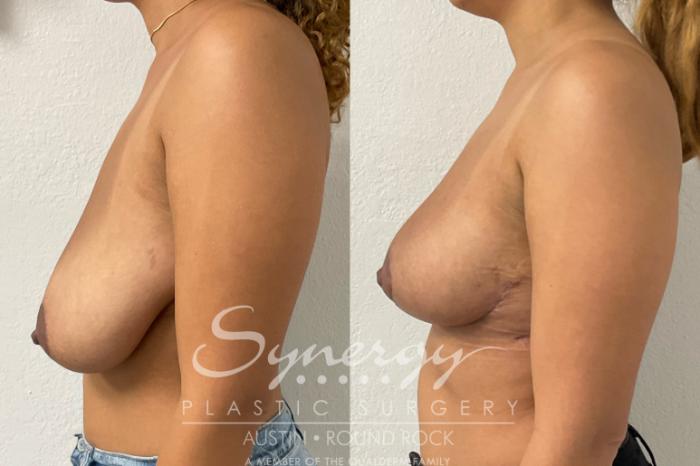 Before & After Breast Reduction Case 927 Left Side View in Austin, TX