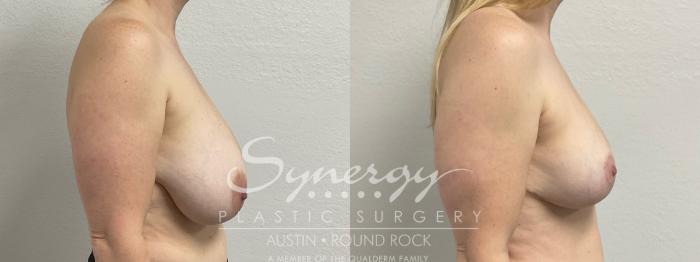 Before & After Breast Reduction Case 948 Right Side View in Austin, TX