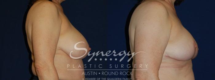 Before & After Breast Reduction Case 98 View #1 View in Austin, TX