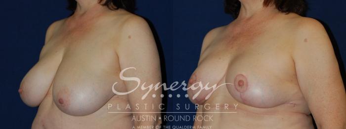 Before & After Breast Reduction Case 98 View #2 View in Austin, TX