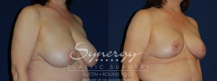Before & After Breast Reduction Case 98 View #3 View in Austin, TX