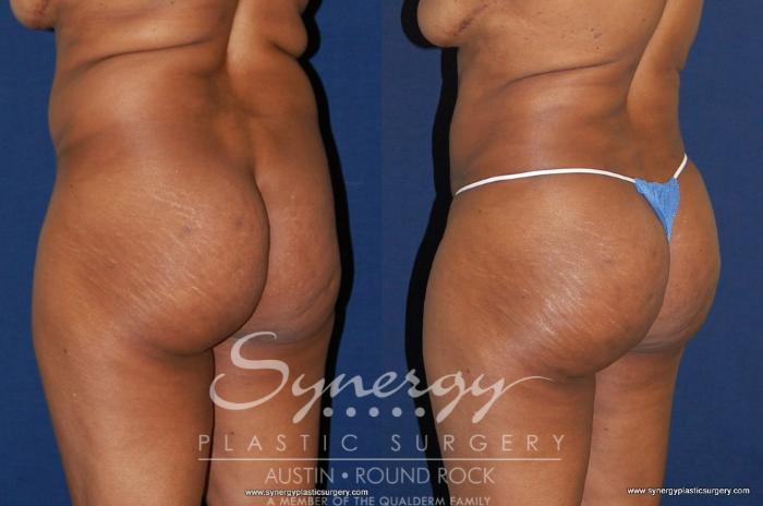 Before & After Buttock Augmentation/Brazilian Butt Lift Case 180 View #1 View in Austin, TX