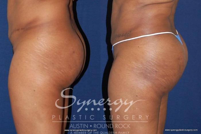 Before & After Buttock Augmentation/Brazilian Butt Lift Case 180 View #2 View in Austin, TX