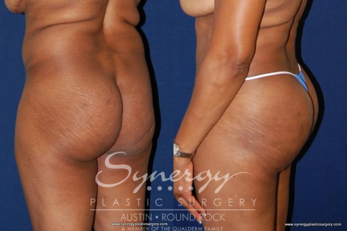 Before & After Buttock Augmentation/Brazilian Butt Lift Case 180 View #3 View in Austin, TX
