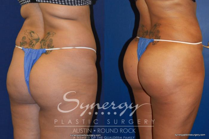 Before & After Buttock Augmentation/Brazilian Butt Lift Case 210 View #2 View in Austin, TX
