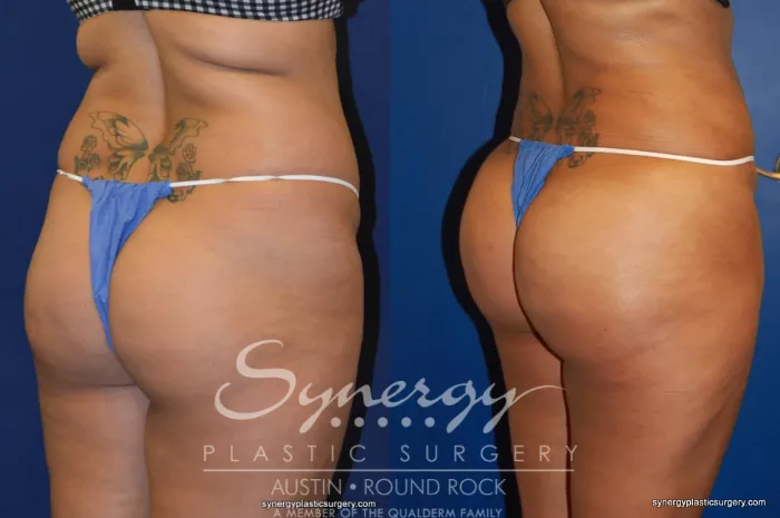 Buttock Augmentation/Brazilian Butt Lift Before and After Pictures Case 262, Austin, TX