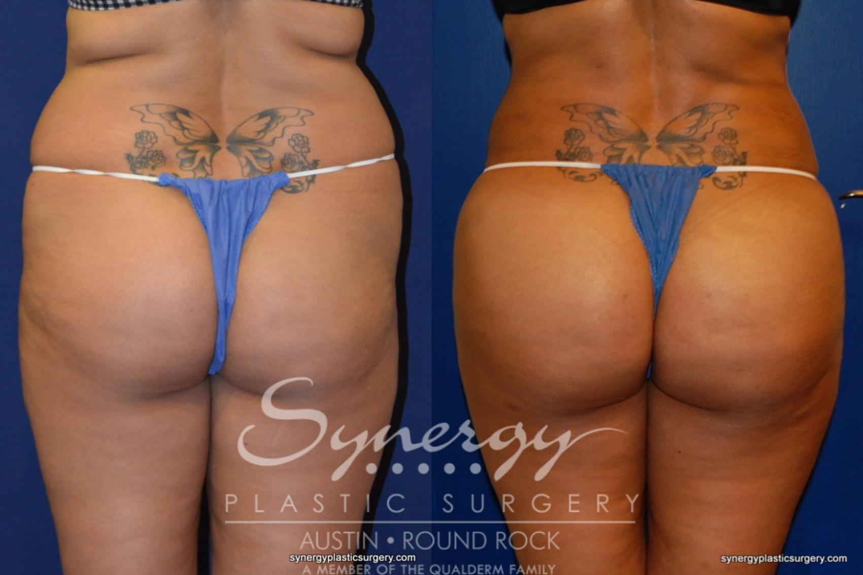 Before & After Buttock Augmentation/Brazilian Butt Lift Case 210 View #3 View in Round Rock, TX