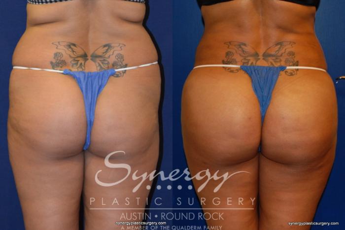 Before & After Buttock Augmentation/Brazilian Butt Lift Case 210 View #3 View in Austin, TX