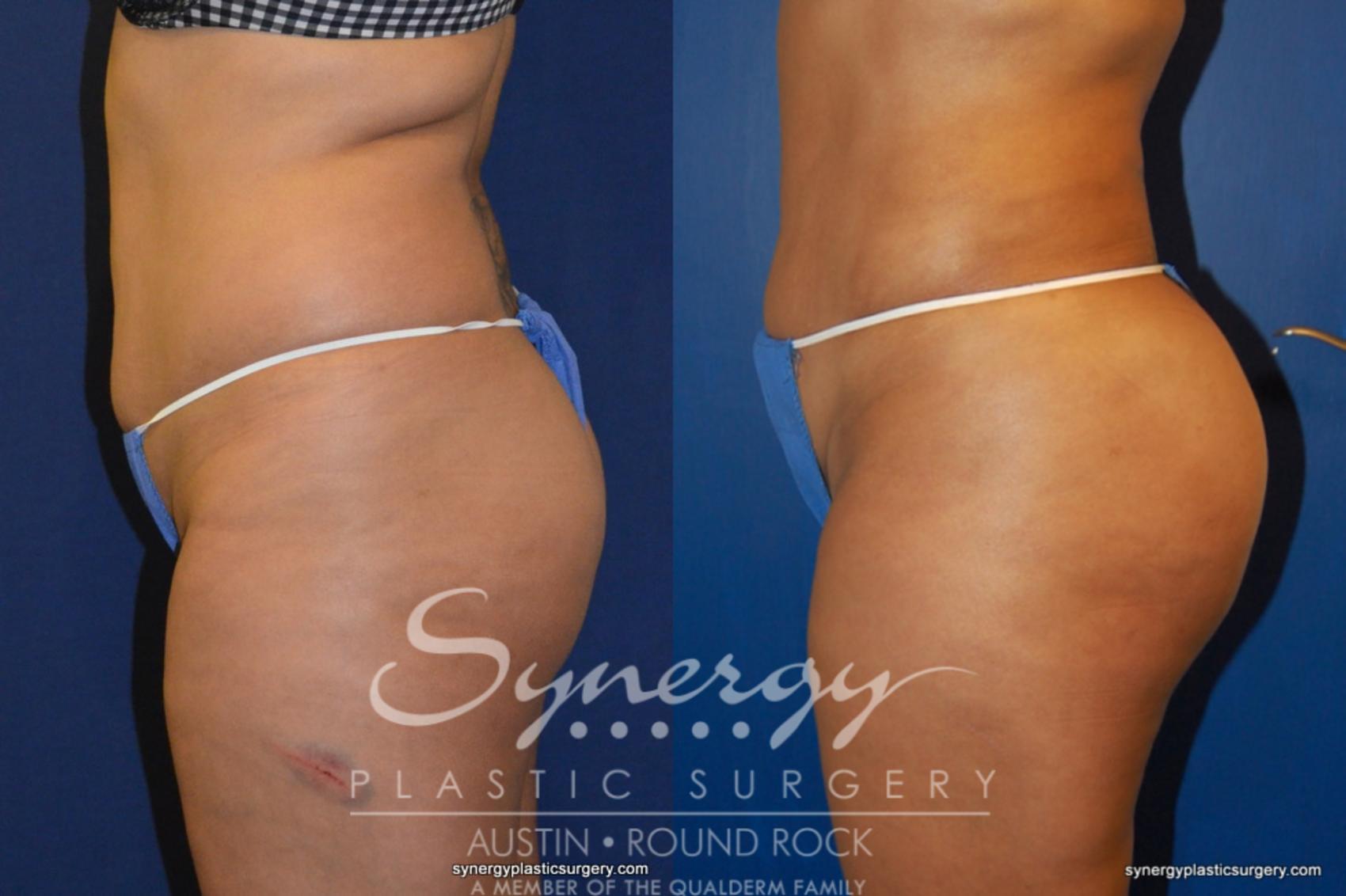 Before & After Buttock Augmentation/Brazilian Butt Lift Case 210 View #4 View in Round Rock, TX