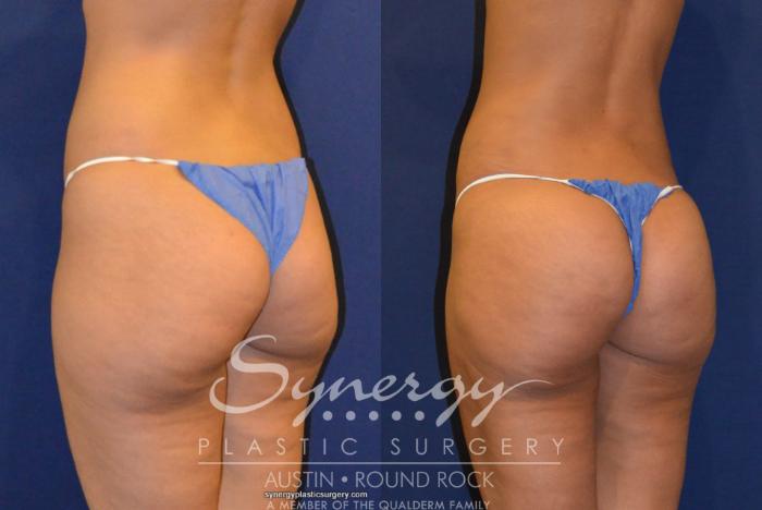 Before & After Buttock Augmentation/Brazilian Butt Lift Case 219 View #3 View in Austin, TX