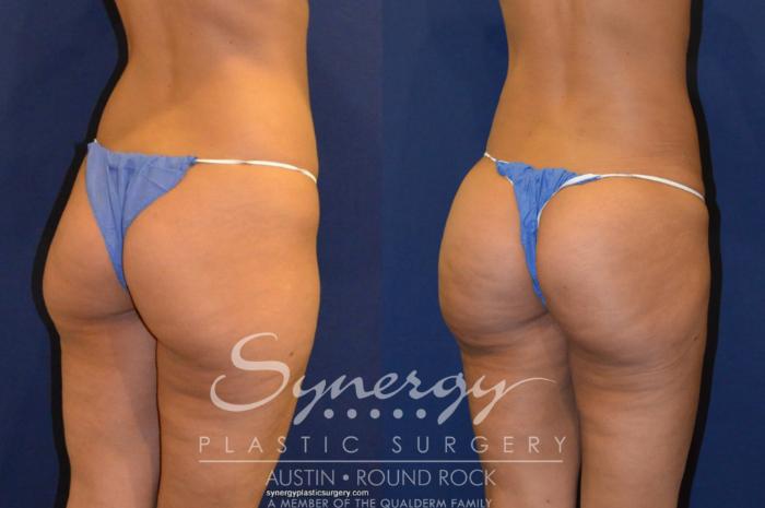 Before & After Buttock Augmentation/Brazilian Butt Lift Case 219 View #4 View in Austin, TX