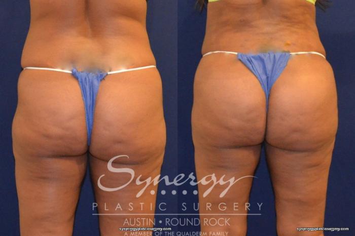 Before & After Buttock Augmentation/Brazilian Butt Lift Case 226 View #2 View in Austin, TX