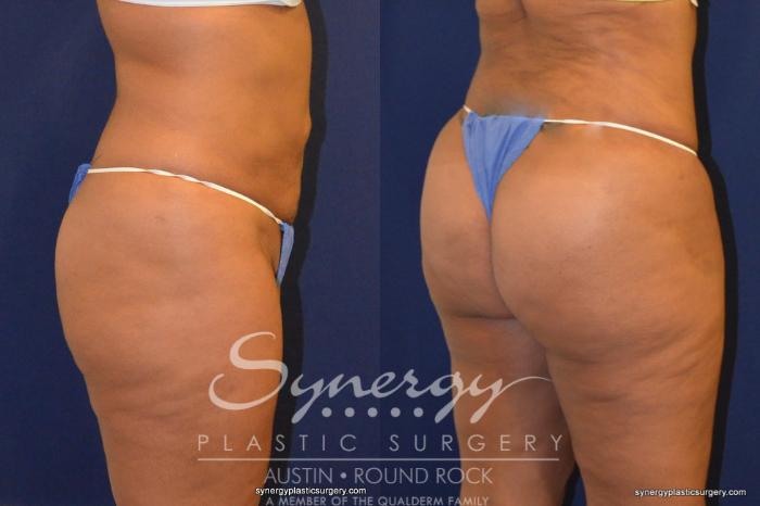 Before & After Buttock Augmentation/Brazilian Butt Lift Case 226 View #4 View in Austin, TX