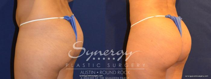 Before & After Buttock Augmentation/Brazilian Butt Lift Case 257 View #1 View in Austin, TX