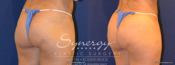 Before & After Buttock Augmentation/Brazilian Butt Lift Case 257 View #2 View in Austin, TX