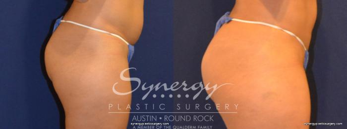 Before & After Buttock Augmentation/Brazilian Butt Lift Case 257 View #3 View in Austin, TX