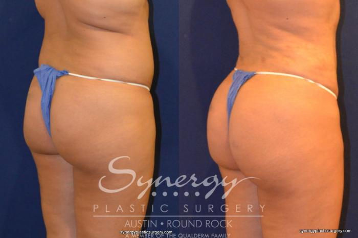 Before & After Buttock Augmentation/Brazilian Butt Lift Case 258 View #1 View in Austin, TX