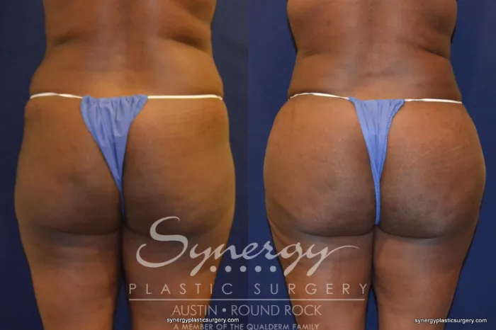 Brazilian Buttock Lift Before and After Pictures Case 294, Gilbert, AZ