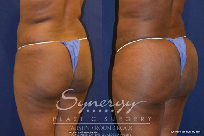 Before & After Buttock Augmentation/Brazilian Butt Lift Case 262 View #2 View in Austin, TX