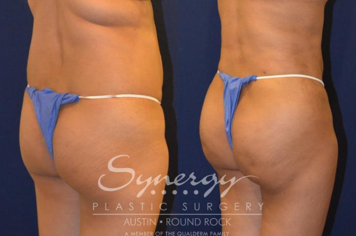 Before & After Buttock Augmentation/Brazilian Butt Lift Case 291 View #3 View in Austin, TX