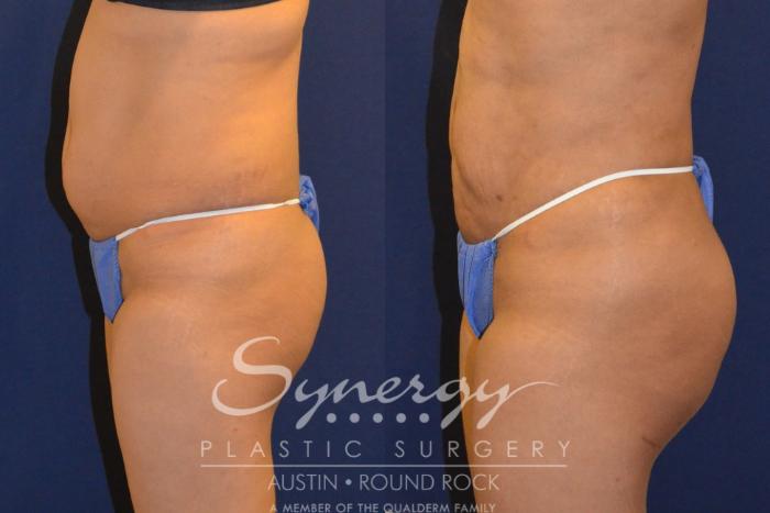 Before & After Buttock Augmentation/Brazilian Butt Lift Case 291 View #4 View in Austin, TX