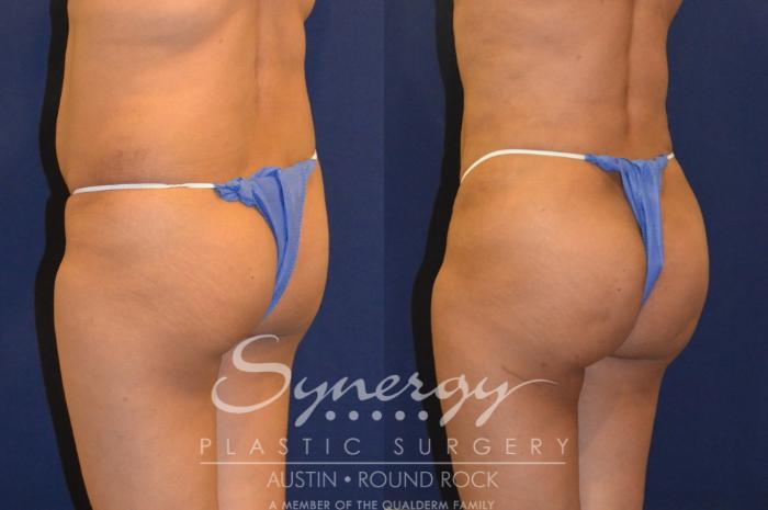 Before & After Buttock Augmentation/Brazilian Butt Lift Case 291 View #5 View in Austin, TX