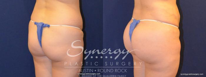 Before & After Buttock Augmentation/Brazilian Butt Lift Case 338 View #2 View in Austin, TX