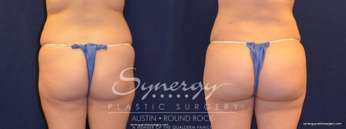 Before & After Buttock Augmentation/Brazilian Butt Lift Case 338 View #3 View in Austin, TX