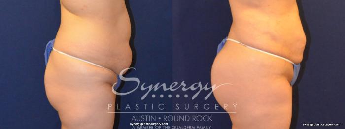 Before & After Buttock Augmentation/Brazilian Butt Lift Case 338 View #4 View in Austin, TX