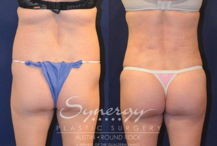 Before & After Buttock Augmentation/Brazilian Butt Lift Case 383 View #2 View in Austin, TX