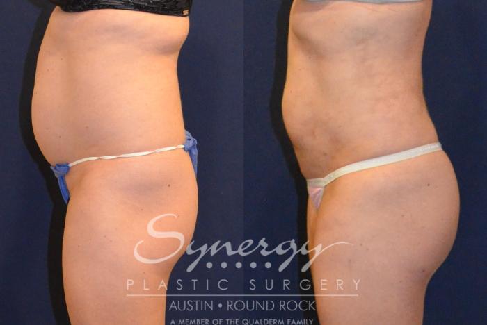 Before & After Buttock Augmentation/Brazilian Butt Lift Case 383 View #3 View in Austin, TX