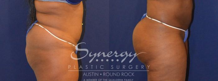 Before & After Buttock Augmentation/Brazilian Butt Lift Case 387 View #1 View in Austin, TX