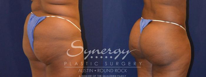 Before & After Buttock Augmentation/Brazilian Butt Lift Case 387 View #2 View in Austin, TX