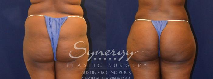 Before & After Buttock Augmentation/Brazilian Butt Lift Case 387 View #3 View in Austin, TX