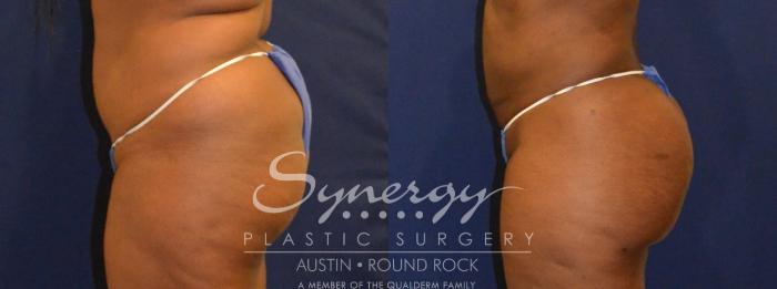 Before & After Buttock Augmentation/Brazilian Butt Lift Case 387 View #4 View in Austin, TX