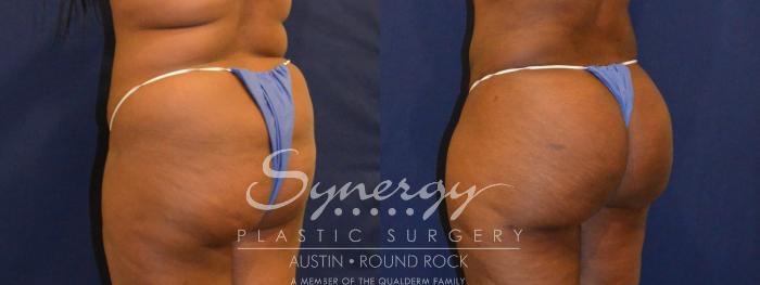 Before & After Buttock Augmentation/Brazilian Butt Lift Case 387 View #5 View in Austin, TX