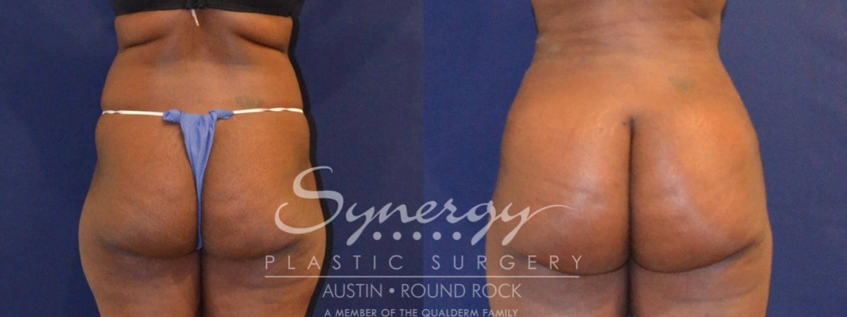 Before & After Buttock Augmentation/Brazilian Butt Lift Case 391 View #1 View in Austin, TX