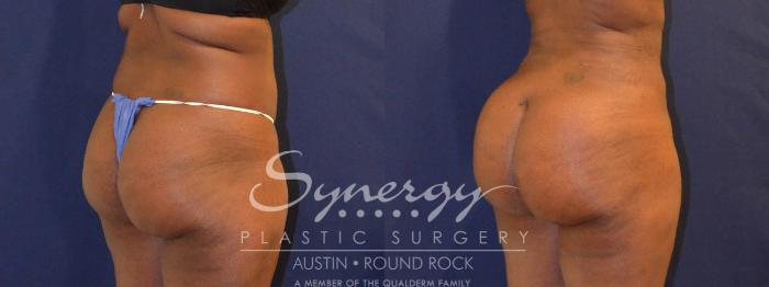 Before & After Buttock Augmentation/Brazilian Butt Lift Case 391 View #2 View in Austin, TX