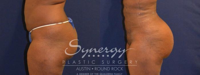 Before & After Buttock Augmentation/Brazilian Butt Lift Case 391 View #3 View in Austin, TX