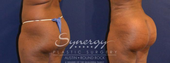 Before & After Buttock Augmentation/Brazilian Butt Lift Case 391 View #4 View in Austin, TX