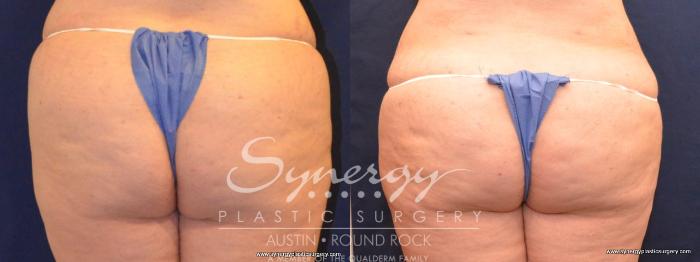 Before & After Buttock Augmentation/Brazilian Butt Lift Case 418 View #1 View in Austin, TX