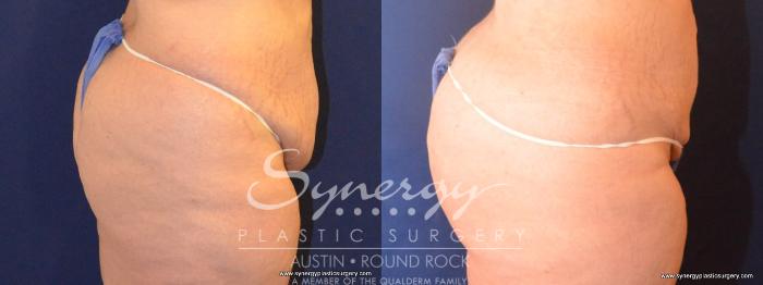 Before & After Buttock Augmentation/Brazilian Butt Lift Case 418 View #2 View in Austin, TX