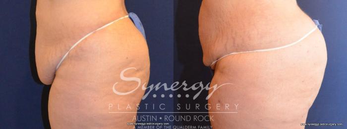 Before & After Buttock Augmentation/Brazilian Butt Lift Case 418 View #3 View in Austin, TX