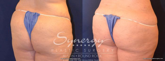 Before & After Buttock Augmentation/Brazilian Butt Lift Case 418 View #4 View in Austin, TX