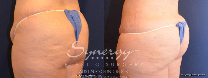 Before & After Buttock Augmentation/Brazilian Butt Lift Case 418 View #5 View in Austin, TX