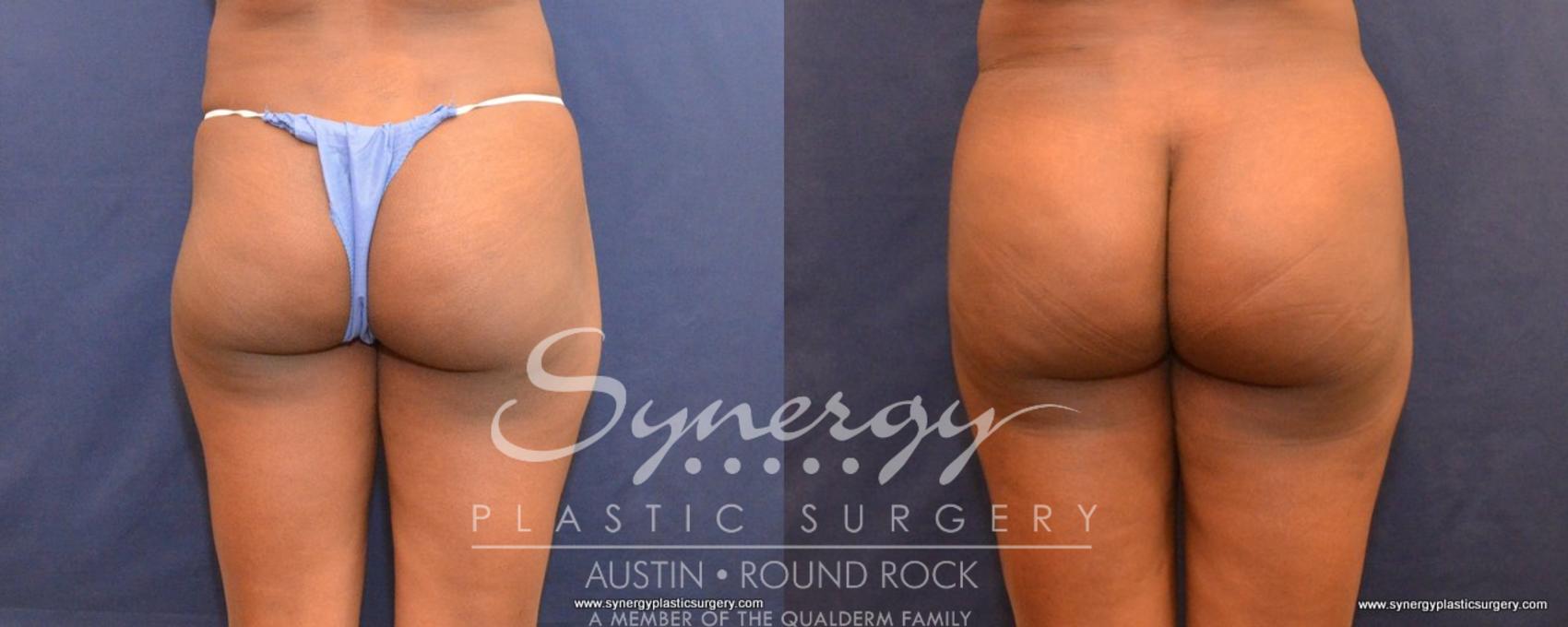 Before & After Buttock Augmentation/Brazilian Butt Lift Case 497 View #1 View in Austin, TX