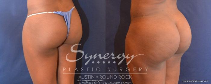 Before & After Buttock Augmentation/Brazilian Butt Lift Case 497 View #2 View in Austin, TX